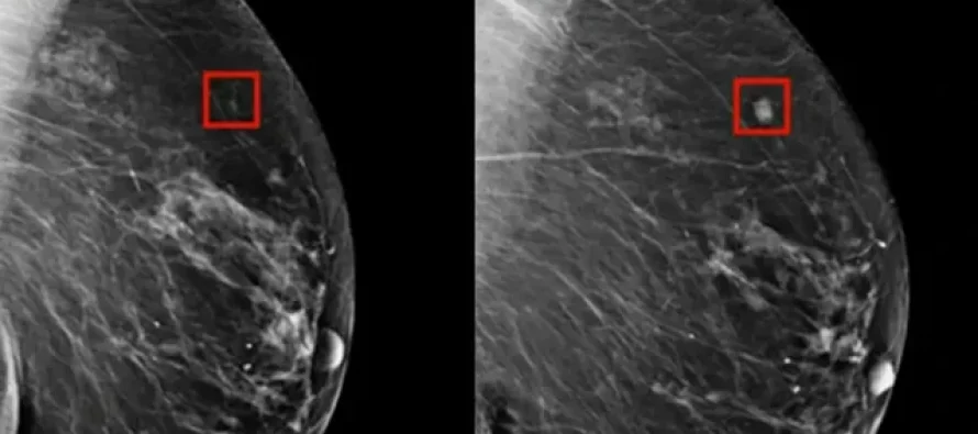 Programi i Inteligjencës Artificiale zbulon kancerin e gjirit 4 vjet para se të zhvillohet