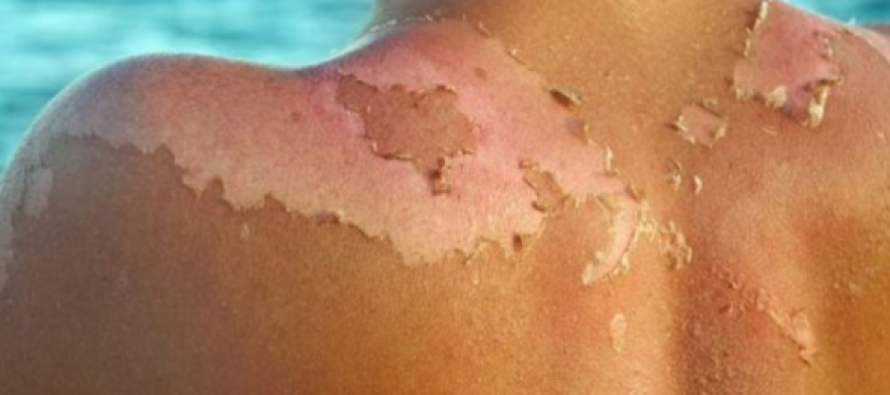 Vera ka ardhur dhe çfarë ndikohet më së shumti është lëkura?!