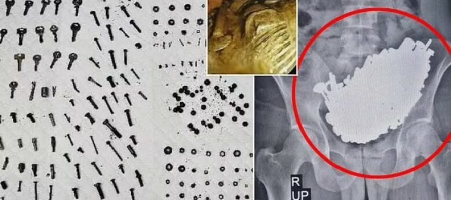 Mjekët i hoqën nga barku burrit nga Irani mbi 450 objekte metalike – kishte gëlltitur çelësa – bulona e pllaka