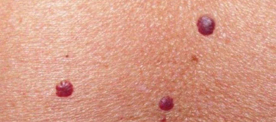 Nishanet e kuqe në trup – sinjal për shëndetin apo thjesht estetikë?