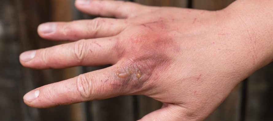 Si të veproni në rast djegieje: këshillat e mjekëve