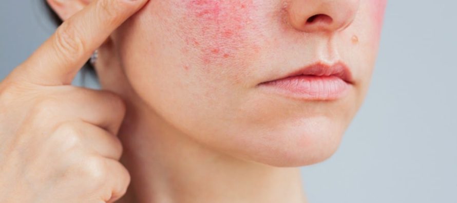 Rozacea, sëmundja kronike e lëkurës që prek fytyrën dhe shpesh edhe sytë